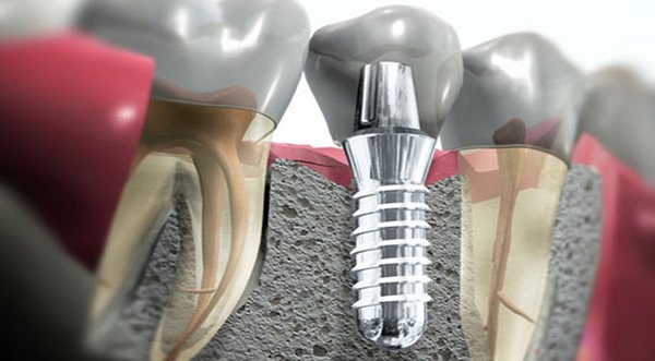 Implantologia-Dentale-Protesi-Termoli